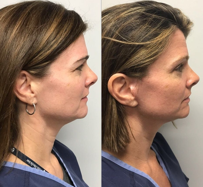 Facelift before and after photo