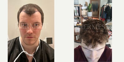FUE Hair Transplant before and after photo
