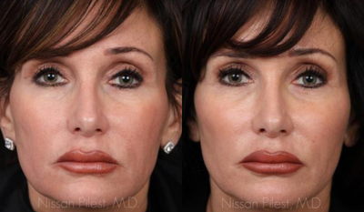 Radiesse before and after photo