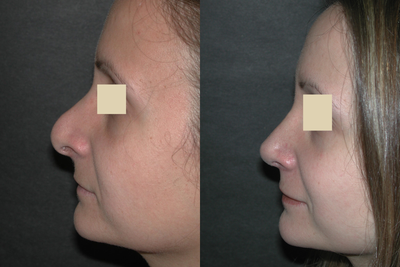 Revision Rhinoplasty before and after photo