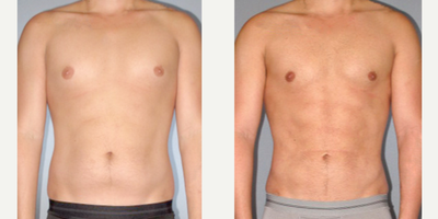 Abdominal Etching before and after photo