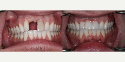 Dental Implants before and after photo