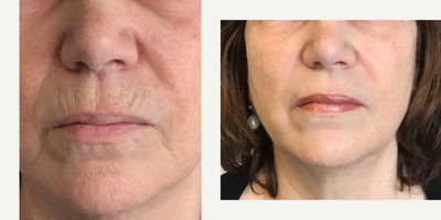 Lip Fillers before and after photo