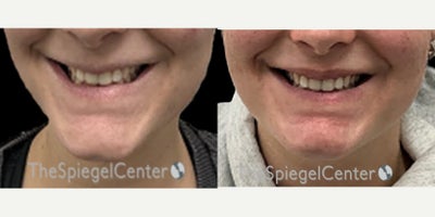 Lip Fillers before and after photo