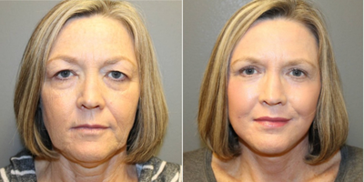 Neck Lift before and after photo