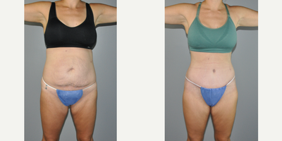 Tummy Tuck before and after photo
