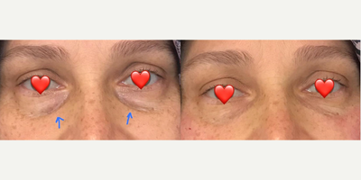 Dermal Fillers before and after photo