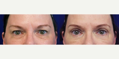Eyelid Surgery before and after photo