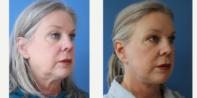 Eyelid Surgery before and after photo