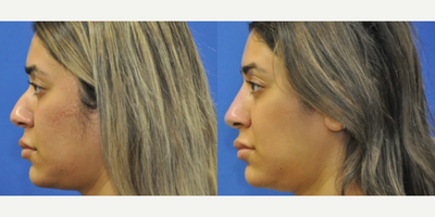 Nonsurgical Nose Job before and after photo
