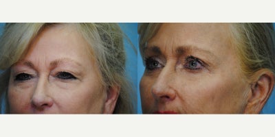 Brow Lift before and after photo