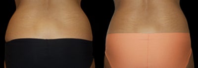 CoolSculpting before and after photo