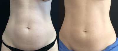 CoolSculpting before and after photo