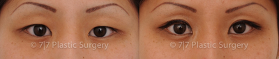 Double Eyelid Surgery before and after photo