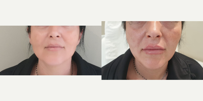 Lip Fillers before and after photo