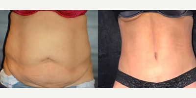 Liposuction before and after photo