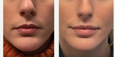 Restylane before and after photo