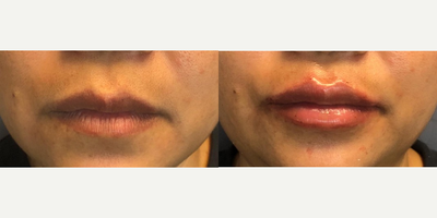 Revanesse before and after photo