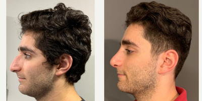 Rhinoplasty before and after photo
