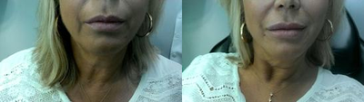 Belotero before and after photo