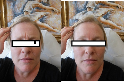 Botox before and after photo