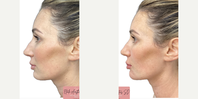 Chin Filler before and after photo