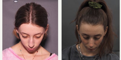 Chin Implant before and after photo