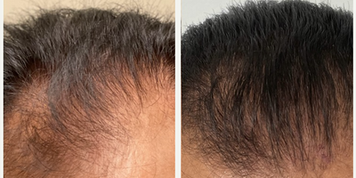 Hair Transplant before and after photo