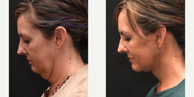 Neck Lift before and after photo