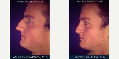 Rhinoplasty before and after photo