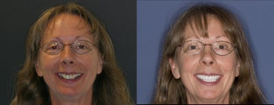 Smile Makeover before and after photo