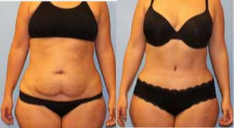 Tummy Tuck before and after photo