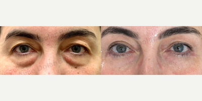 Facial Fat Transfer before and after photo