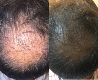 PRP for Hair Loss before and after photo