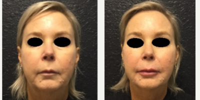 Voluma before and after photo