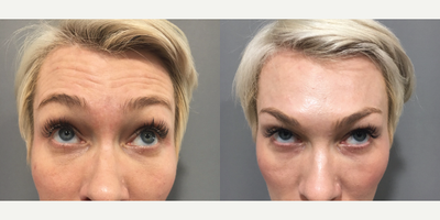 Botox before and after photo