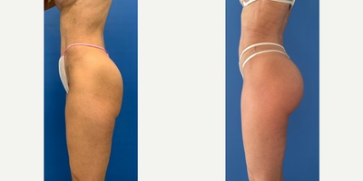 Butt Implants before and after photo