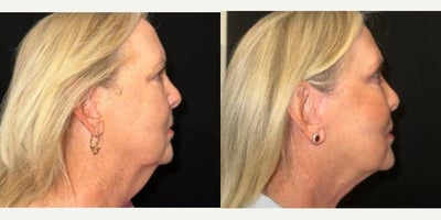 Facelift before and after photo
