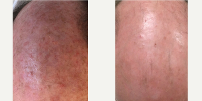 Fraxel Laser before and after photo