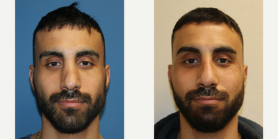 Rhinoplasty before and after photo