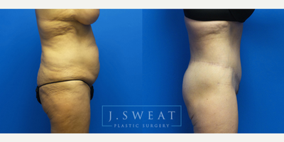 Body Lift before and after photo