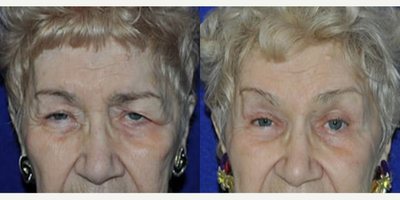 Brow Lift before and after photo
