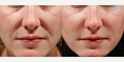 Juvederm before and after photo