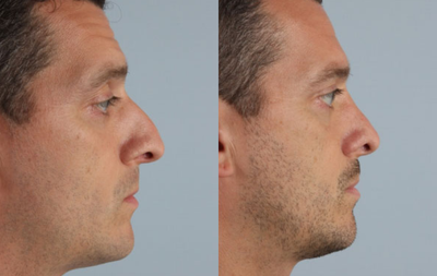 Rhinoplasty before and after photo