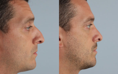 Rhinoplasty before and after photo
