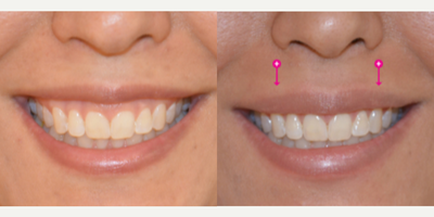 Botox for Gummy Smile before and after photo