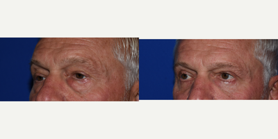 Eyelid Surgery before and after photo