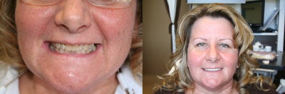 Porcelain Veneers before and after photo