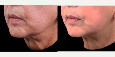 Ultherapy before and after photo