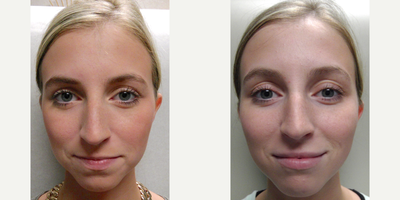 Volbella before and after photo